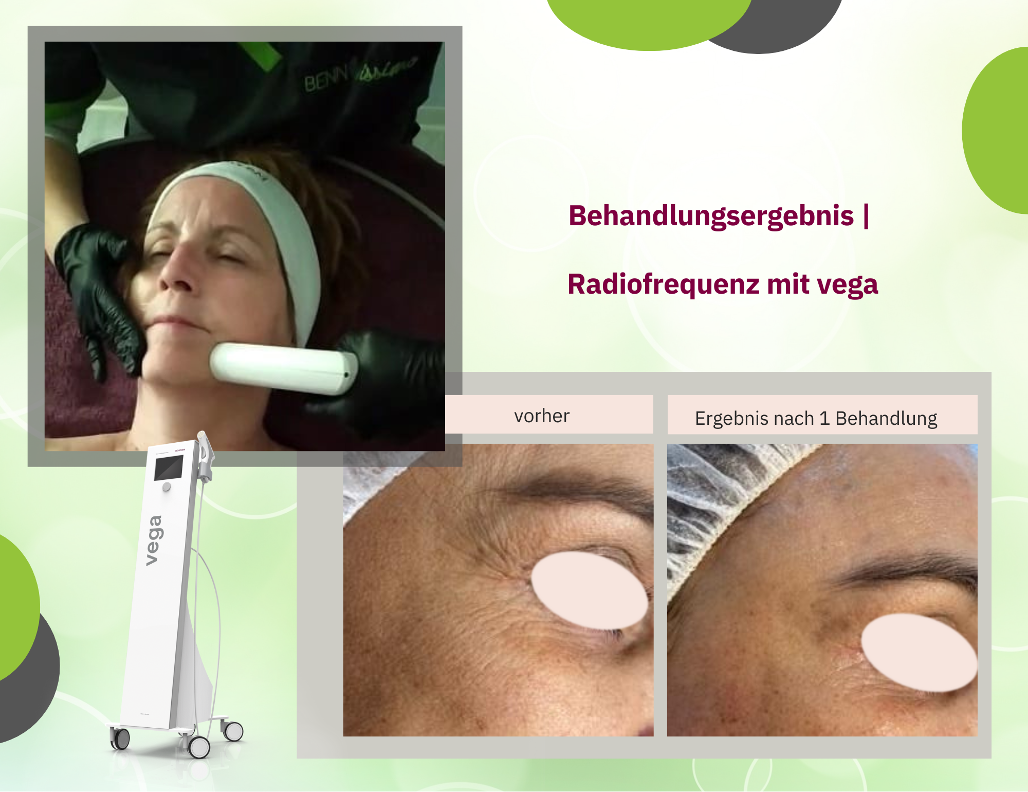 Kopie von Vega ist Mega Vorher-Nacher Ergbenisse einer Vega-Bahndlung